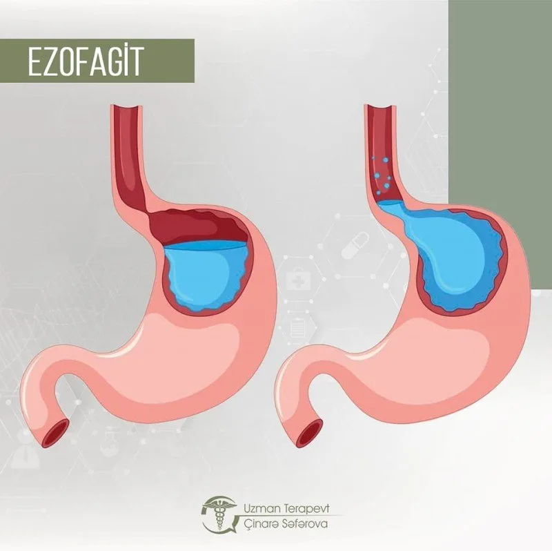 Həzm traktının geniş yayılmış xəstəliklərindən biri - Ezofagit