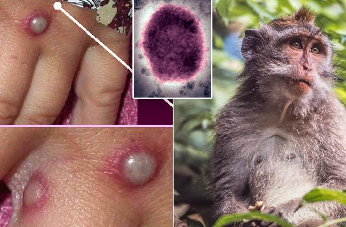 İndi də Meymun çiçəyi virusu gəlir