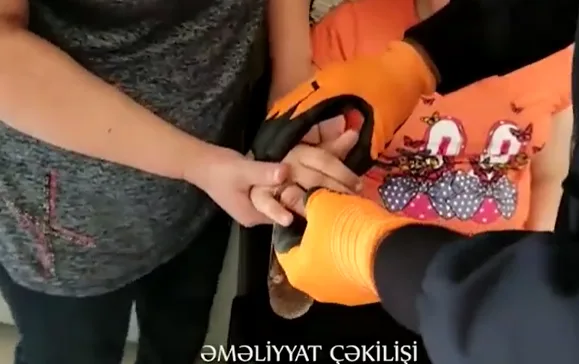 Uşağın barmağında qalan dəmir halqa belə çıxarıldı - VİDEO