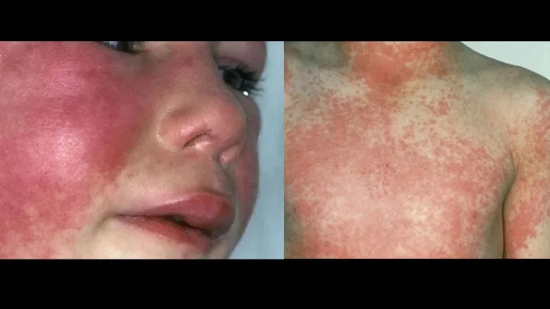 Yeni epidemiya qorxusu: Gənc ailələr diqqətli olsunlar