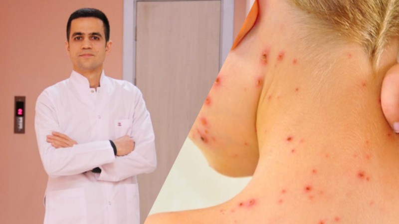 Suçiçəyi mövsümü: İnfeksionist xəstəlikdən qorunma yollanını göstərir