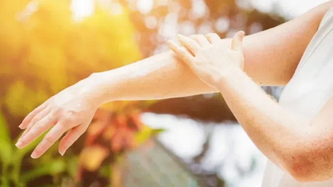 Günəş şüası dəridə bu xəstəliyə səbəb olur -DERMATOLOQ AÇIQLAYIR