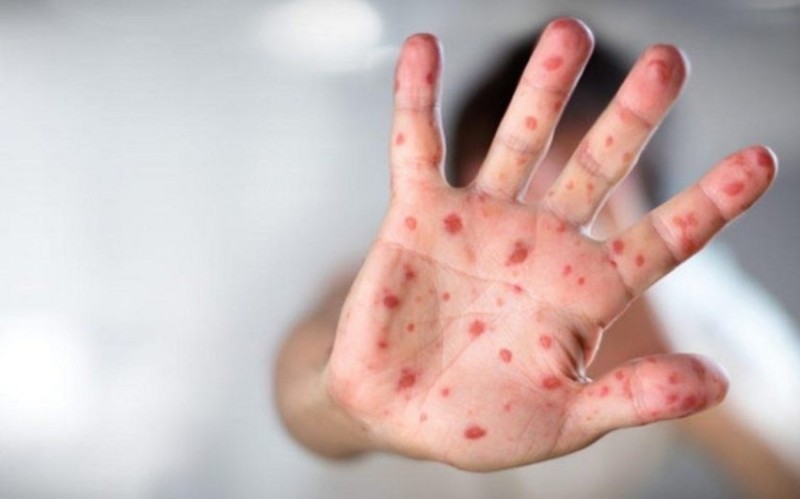 Bu ölkədə qızılca epidemiyası elan edildi