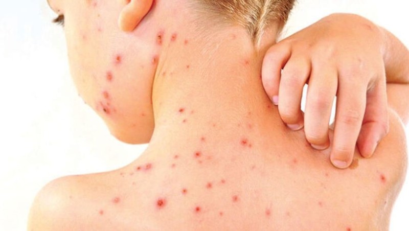 İki körpə qızılcadan ÖLDÜ