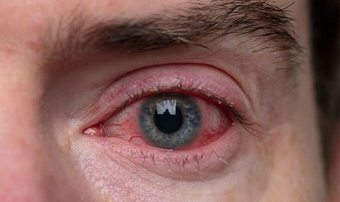 Qırmızı göz xəstəliyi: 7500 yoluxma