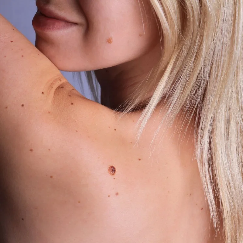 İngiltərədə melanoma dəri xərçənginə yoluxma artıb
