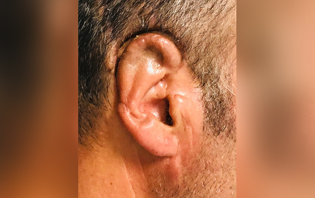 Qopan qulağı 34 saat sonra yerinə tikildi - FOTO