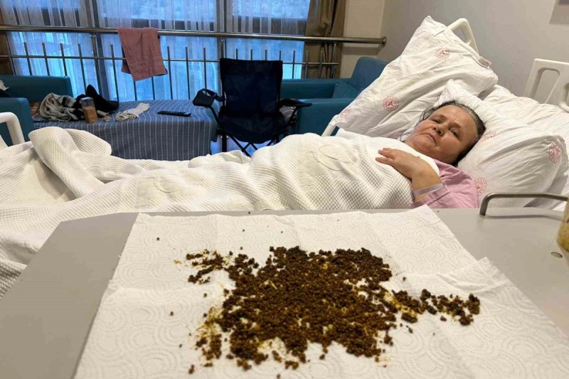 Pasiyentin öd kisəsindən 20 mindən çox daş çıxarılıb