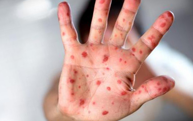 Ölkədə qızılca və suçiçəyi ilə bağlı vəziyyət necədir? - RƏSMİ