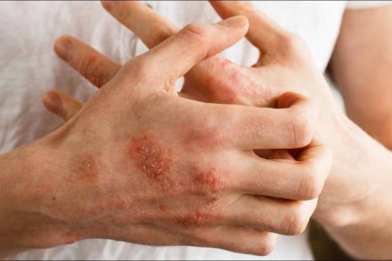 İxtioz xəstələrinin SAYI AÇIQLANDI