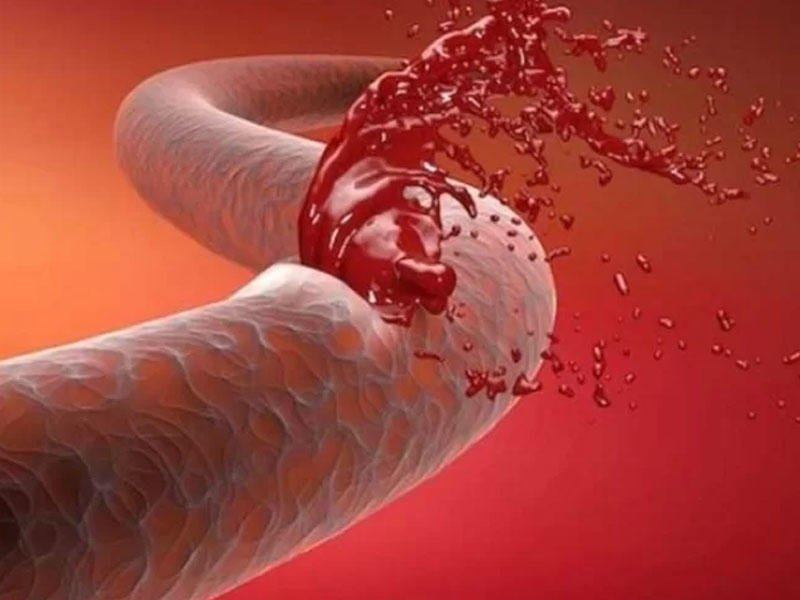 Həkim: Avtomobil qəzalarında daxili qanaxma gizli ola bilər