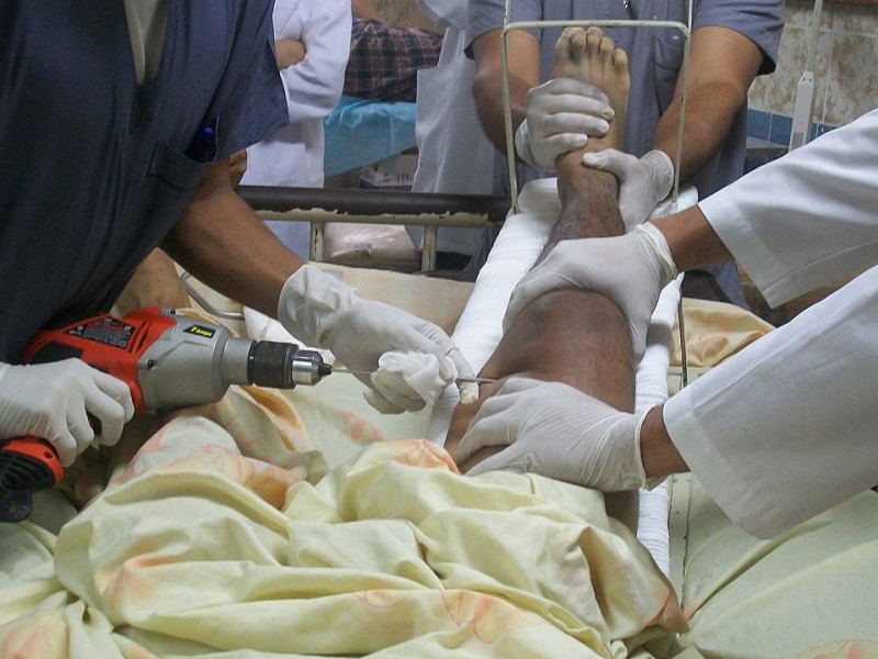 Travmalardan sonra gips mütləqdirmi? - Həkim AÇIQLADI