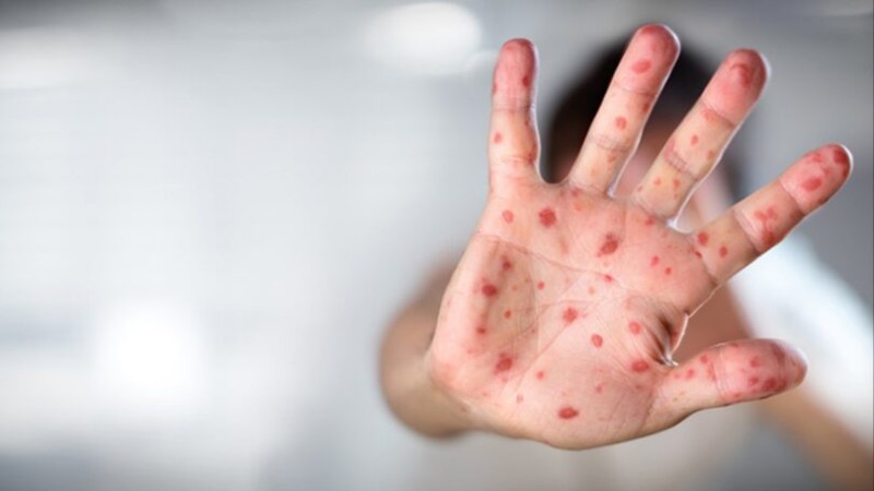 Rusiyada meymunçiçəyinə ikinci yoluxma faktı qeydə alındı - YENİLƏNİB