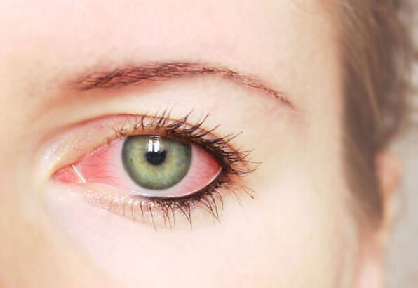 Qlaukoma və quru gözdən necə qorunmaq olar?