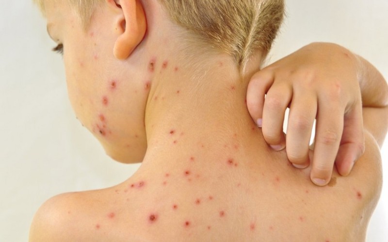 Bu ölkədə qızılca xəstəliyi yayıldı