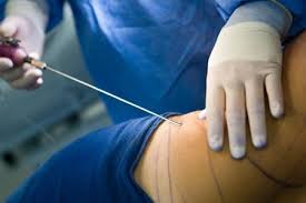 Keysəriyyə zamanı plastik əməliyyat etmək düzgündürmü?