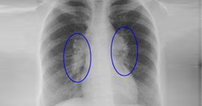 Sarkoidozu vaxtında tanıyın - Həkimlərdən XƏBƏRDARLIQ