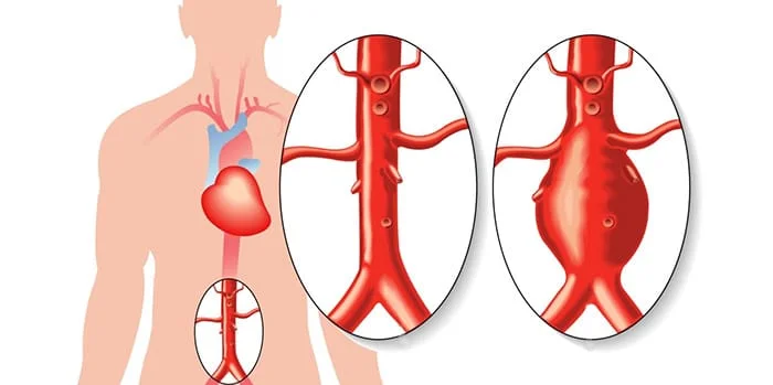 Anevrizma barədə əsas məlumatlar: risklər, simptomlar və müalicə