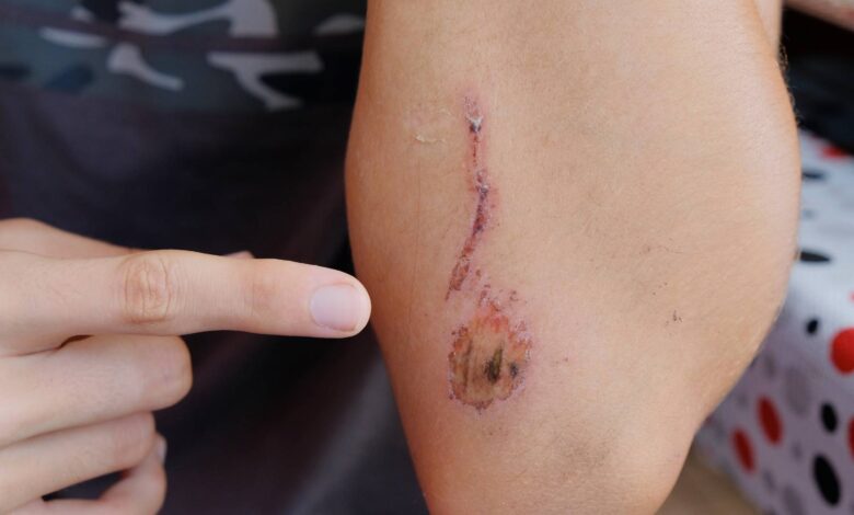 Kalsium çoxluğu ölümcül ola bilərmi? - RİSKLƏR AÇIQLANDI