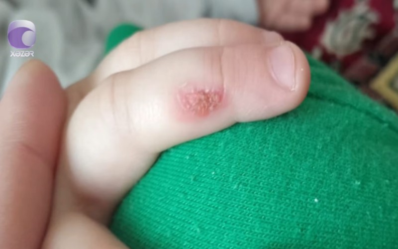 Bağçada uşağın əlinin yandırılması iddiasına RƏSMİ MÜNASİBƏT