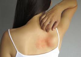 Allergiya NƏDƏN ASILIDIR?