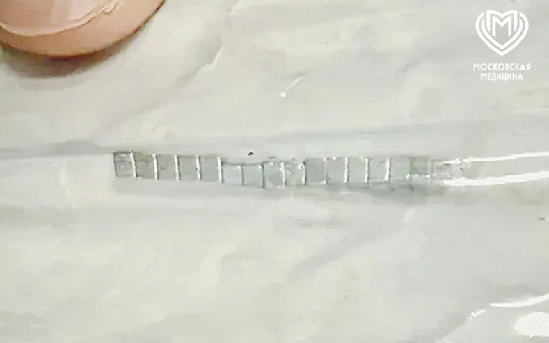 10 yaşlı uşağın burnundan 16 maqnit çıxarıldı