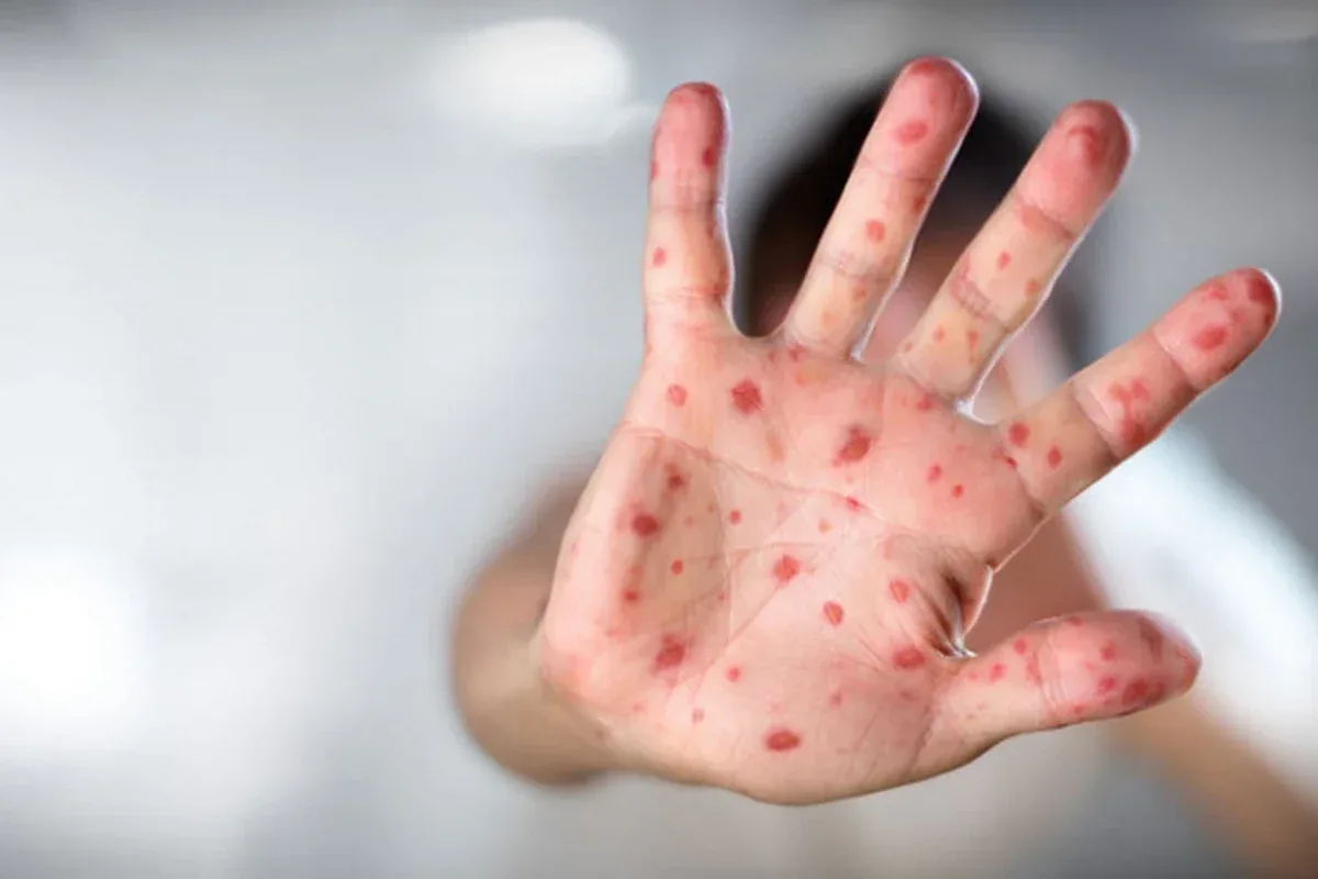 Qızılca və suçiçəyi ilə bağlı epidemioloji vəziyyət - RƏSMİ