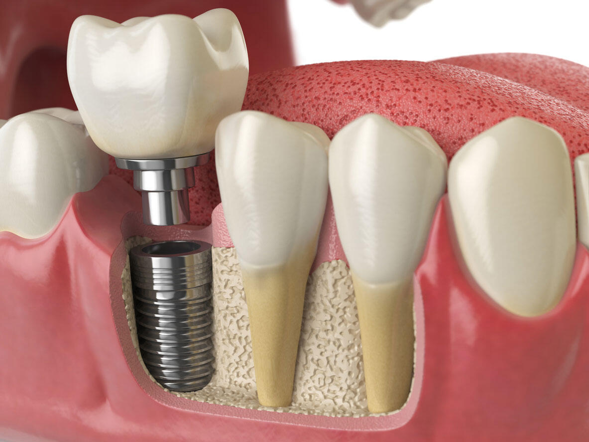 Cənubi Koreyada 11 diş implantı qoyulan 75 yaşlı qadın öldü