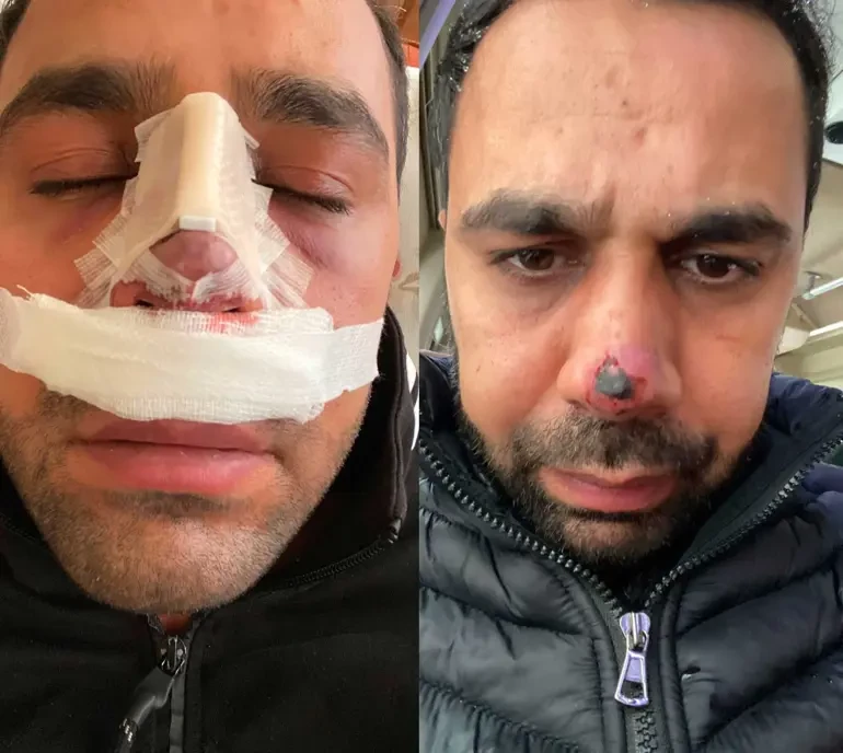 İkinci dəfə estetik əməliyyat olundu: burnu çürüdü