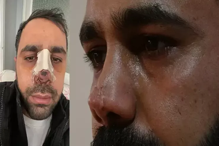 İkinci dəfə estetik əməliyyat olundu: burnu çürüdü