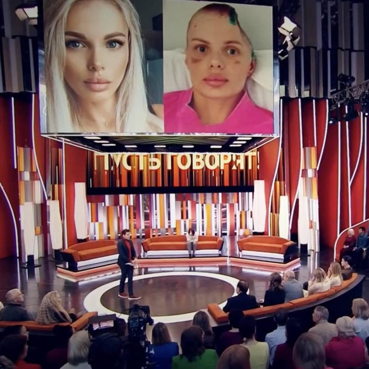 Model sevgilisi tərəfindən vəhşicəsinə döyüldü – Kəllə sümüyünün yarısını itirib